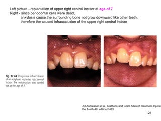 26
Left picture - replantation of upper right central incisor at age of 7
Right - since periodontal cells were dead,
ankylosis cause the surrounding bone not grow downward like other teeth,
therefore the caused infraocclusion of the upper right central incisor
JO Andreasen et al. Textbook and Color Atlas of Traumatic Injuries
the Teeth 4th edition P473
 