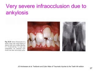 27
Very severe infraocclusion due to
ankylosis
JO Andreasen et al. Textbook and Color Atlas of Traumatic Injuries to the Teeth 4th edition
 