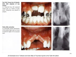 28
JO Andreasen et al. Textbook and Color Atlas of Traumatic Injuries to the Teeth 4th edition
 