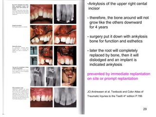 29
-Ankylosis of the upper right cental
incisor
- therefore, the bone around will not
grow like the others downward
for 4 years
- surgery put it down with ankylosis
bone for function and esthetics
- later the root will completely
replaced by bone, then it will
dislodged and an implant is
indicated ankylosis
prevented by immediate replantation
on site or prompt replantation
JO Andreasen et al. Textbook and Color Atlas of
Traumatic Injuries to the Teeth 4th
edition P.786
 