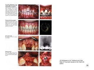 30
JO Andreasen et al. Textbook and Color
Atlas of Traumatic Injuries to the Teeth 4th
edition
 