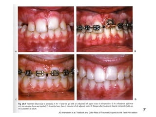 31
JO Andreasen et al. Textbook and Color Atlas of Traumatic Injuries to the Teeth 4th edition
 