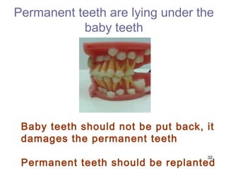 32
Permanent teeth are lying under the
baby teeth
Baby teeth should not be put back, it
damages the permanent teeth
Permanent teeth should be replanted
 
