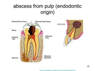 45
abscess from pulp (endodontic
origin)
http://monicaalegre.ifunnyblog.com/abscessafterapicoectomy/
 