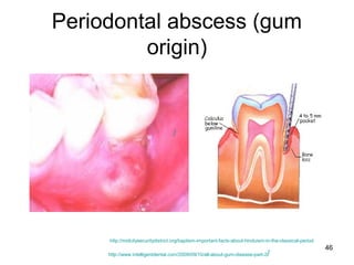46
Periodontal abscess (gum
origin)
http://www.intelligentdental.com/2009/09/10/all-about-gum-disease-part-2/
/
http://midcitysecuritydistrict.org/baptism-important-facts-about-hinduism-in-the-classical-period
 