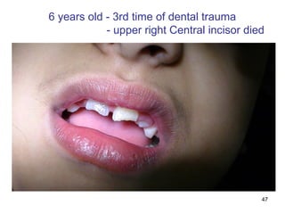 47
6 years old - 3rd time of dental trauma
- upper right Central incisor died
 