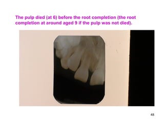 48
The pulp died (at 6) before the root completion (the root
completion at around aged 9 if the pulp was not died).
 