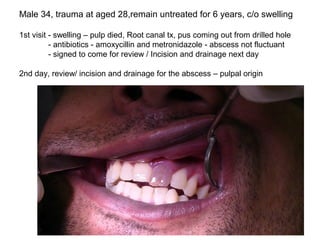 49
Male 34, trauma at aged 28,remain untreated for 6 years, c/o swelling
1st visit - swelling – pulp died, Root canal tx, pus coming out from drilled hole
- antibiotics - amoxycillin and metronidazole - abscess not fluctuant
- signed to come for review / Incision and drainage next day
2nd day, review/ incision and drainage for the abscess – pulpal origin
 
