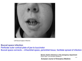 53
Buccal space infection
Perforate outer cortical plate of jaw to buccinator
Buccal space connects – infraorbital space, periorbital tissue, facilitate spread of infection
 