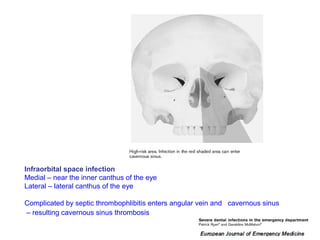55
Infraorbital space infection
Medial – near the inner canthus of the eye
Lateral – lateral canthus of the eye
Complicated by septic thrombophlibitis enters angular vein and cavernous sinus
– resulting cavernous sinus thrombosis
 