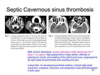 65
Septic Cavernous sinus thrombosis
M49, chronic alcoholism, severe right lower molar dental pain for 7
days ( ? or upper). High graded fever 5 days before, difficulty of
opening his mouth, and swelling of the right buccal area. progressed to
be right-sided temporofrontal area swelling and pain.
2 days later, he developed periorbital swelling, marked right-sided
visual loss. proptosis, chemosis, and progressive total ophthalmoplegia
in both eyes
 