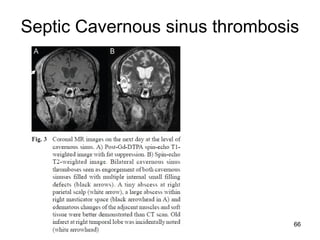 66
Septic Cavernous sinus thrombosis
 