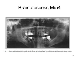 75
Brain abscess M/54
 