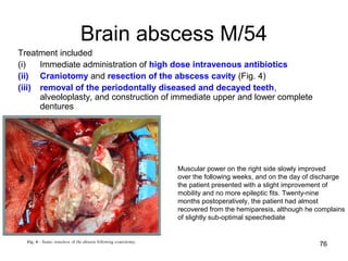 76
Brain abscess M/54
Treatment included
(i) Immediate administration of high dose intravenous antibiotics
(ii) Craniotomy and resection of the abscess cavity (Fig. 4)
(iii) removal of the periodontally diseased and decayed teeth,
alveoloplasty, and construction of immediate upper and lower complete
dentures
Muscular power on the right side slowly improved
over the following weeks, and on the day of discharge
the patient presented with a slight improvement of
mobility and no more epileptic fits. Twenty-nine
months postoperatively, the patient had almost
recovered from the hemiparesis, although he complains
of slightly sub-optimal speechediate
 