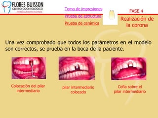 Toma de impresiones
Prueba de estructura
Prueba de cerámica
FASE 4
Realización de
la corona
Una vez comprobado que todos los parámetros en el modelo
son correctos, se prueba en la boca de la paciente.
Colocación del pilar
intermediario
Cofia sobre el
pilar intermediario
pilar intermediario
colocado
 