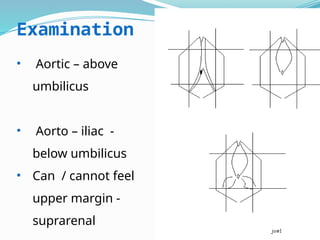 Examination
• Aortic – above
umbilicus
• Aorto – iliac -
below umbilicus
• Can / cannot feel
upper margin -
suprarenal