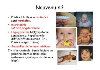Nouveau né
• Poids et taille à la naissance
  sont normales.
• micro pénis
  :<2.5cm,cryptorchidie.
• Hypoglycémie NN(hypotonie,
  somnolence, hypothermie,
  difficultés de succion, BAC,
  Pauses respiratoires)
• Anomalies de la ligne médiane:
Incisive centrale, fente labiale ou
  palatine, hernie ombilicale,
  malvoyance,nystagmus,colobome
  irien)
 