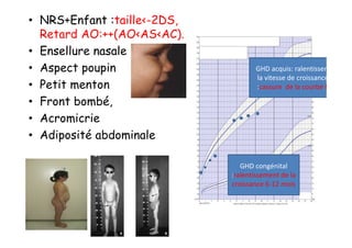 • NRS+Enfant :taille<-2DS,
  Retard AO:++(AO<AS<AC).
• Ensellure nasale
• Aspect poupin                     GHD acquis: ralentissement de
                                    la vitesse de croissance
• Petit menton                      :cassure de la courbe franche

• Front bombé,
• Acromicrie
• Adiposité abdominale

                                GHD congénital
                             :ralentissement de la
                             croissance 6-12 mois
 