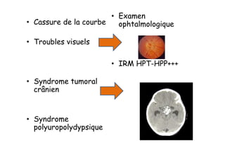 • Examen
• Cassure de la courbe   ophtalmologique

• Troubles visuels

                        • IRM HPT-HPP+++

• Syndrome tumoral
  crânien


• Syndrome
  polyuropolydypsique
 