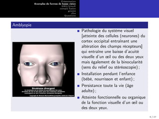 Présentation
Exemples de formes de basse vision
GNU/LinuX
compiz fusion
gnome
xfce
Questions
Amblyopie
Pathologie du système visuel
[atteinte des cellules (neurones) du
cortex occipital entraînant une
altération des champs récepteurs]
qui entraîne une baisse d’acuité
visuelle d’un œil ou des deux yeux
mais également de la binocularité
(sens du relief ou stéréoscopie) ;
Installation pendant l’enfance
(bébé, nourrisson et enfant) ;
Persistance toute la vie (âge
adulte) ;
Atteinte fonctionnelle ou organique
de la fonction visuelle d’un œil ou
des deux yeux.
6 / 27
 