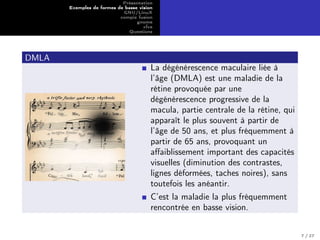 Présentation
Exemples de formes de basse vision
GNU/LinuX
compiz fusion
gnome
xfce
Questions
DMLA
La dégénérescence maculaire liée à
l’âge (DMLA) est une maladie de la
rétine provoquée par une
dégénérescence progressive de la
macula, partie centrale de la rétine, qui
apparaît le plus souvent à partir de
l’âge de 50 ans, et plus fréquemment à
partir de 65 ans, provoquant un
aﬀaiblissement important des capacités
visuelles (diminution des contrastes,
lignes déformées, taches noires), sans
toutefois les anéantir.
C’est la maladie la plus fréquemment
rencontrée en basse vision.
7 / 27
 