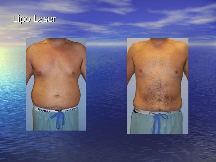 Lipo laser by florida plastic surgery institute