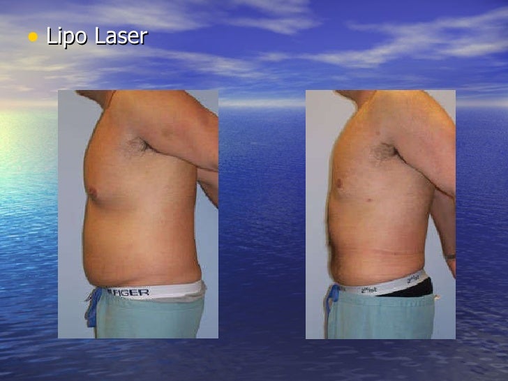 Lipo laser by florida plastic surgery institute