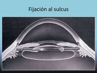 Lentes Intraoculares