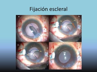 Lentes Intraoculares