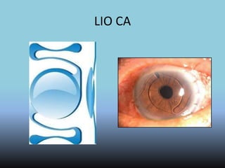 Lentes Intraoculares