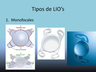 Lentes Intraoculares