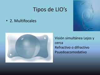 Lentes Intraoculares