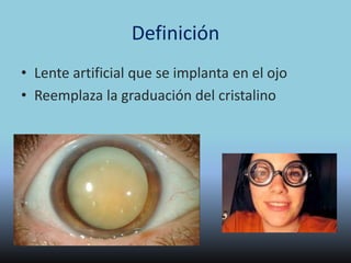 Lentes Intraoculares