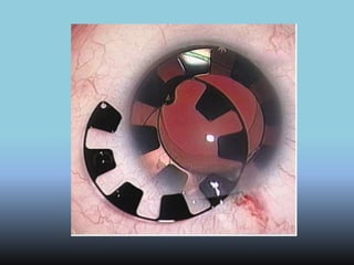 Lentes Intraoculares