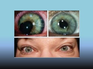 Lente intraocular de color sale