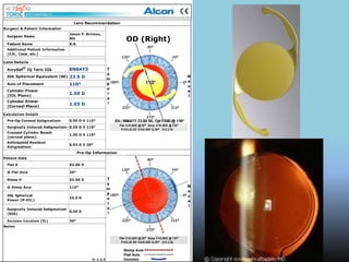 Lentes Intraoculares
