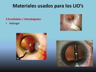 Lentes Intraoculares
