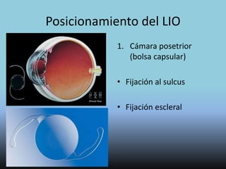 Lentes Intraoculares