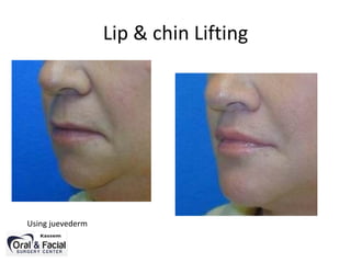 Lip & chin Lifting
Using juevederm
 