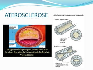 ATEROSCLEROSE
 