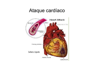 Ataque cardíaco
 
