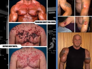 Sem orientação médica, os esteróides provocam
        efeitos colaterais devastadores
 