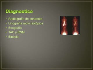 •   Radiografía de contraste
•   Linografía radio isotópica
•   Ecografía
•   TAC y RNM
•   Biopsia
 