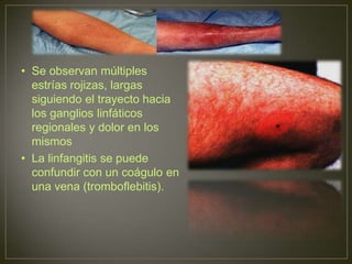 Linfangitis Reticular Lipedema, linfangitis, linfedema | PPTX