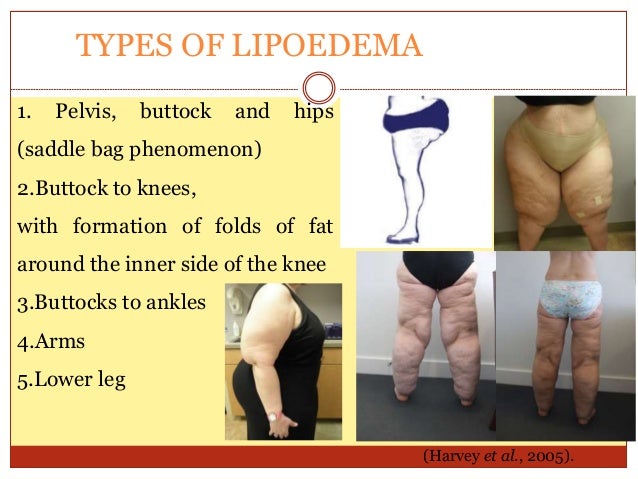 LIPOEDEMA CLINICAL MANIFESTATTIONS DIAGNOSIS AND TREATMENT lipoedema-clinical-manifestattions-diagnosis-and-treatment