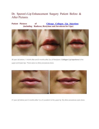 Dr. Speron's Lip Enhancement Surgery Patient Before &
After Pictures
Patient Pictures of Chicago Collagen Lip Injections
(including Radiesse, Restylane and Juvederm for Lips)
36 year old before, 1 month after and 6 months after 2cc of Restylane Collagen Lip Injections to the
upper and lower lips. There were no other procedures done.
41 year old before and 3 months after 1cc of Juvederm to the upper lip. No other procedures were done.
 