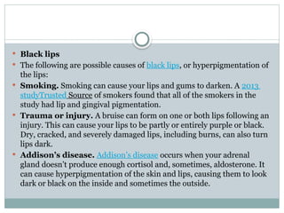  Black lips
 The following are possible causes of black lips, or hyperpigmentation of
the lips:
 Smoking. Smoking can cause your lips and gums to darken. A 2013
studyTrusted Source of smokers found that all of the smokers in the
study had lip and gingival pigmentation.
 Trauma or injury. A bruise can form on one or both lips following an
injury. This can cause your lips to be partly or entirely purple or black.
Dry, cracked, and severely damaged lips, including burns, can also turn
lips dark.
 Addison’s disease. Addison’s disease occurs when your adrenal
gland doesn’t produce enough cortisol and, sometimes, aldosterone. It
can cause hyperpigmentation of the skin and lips, causing them to look
dark or black on the inside and sometimes the outside.
 