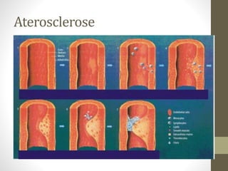 Aterosclerose
 