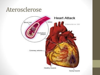 Aterosclerose
Infarto Agudo
 