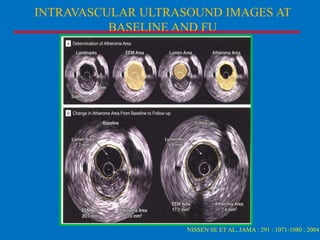 INTRAVASCULAR ULTRASOUND IMAGES AT
BASELINE AND FU

NISSEN SE ET AL, JAMA : 291 : 1071-1080 ; 2004

 